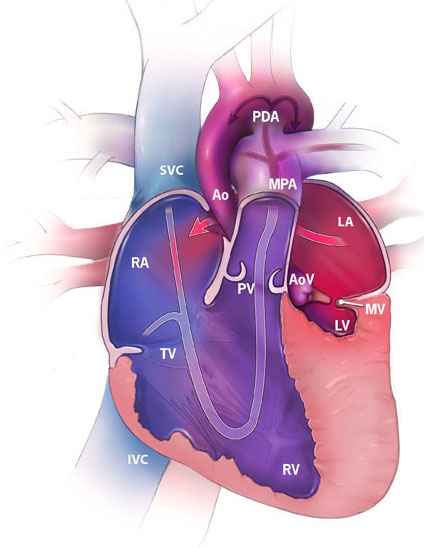 Figure 1. Hypoplastic left heart syndrome illustrating a hypoplastic left ventricle (LV), mitral valve (MV), aortic valve (AoV), and ascending aorta (Ao) (“Facts about…”, 2014).