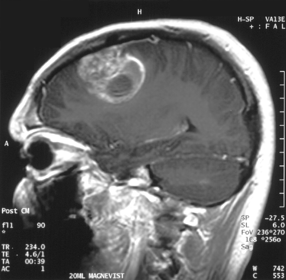 glioblastoma