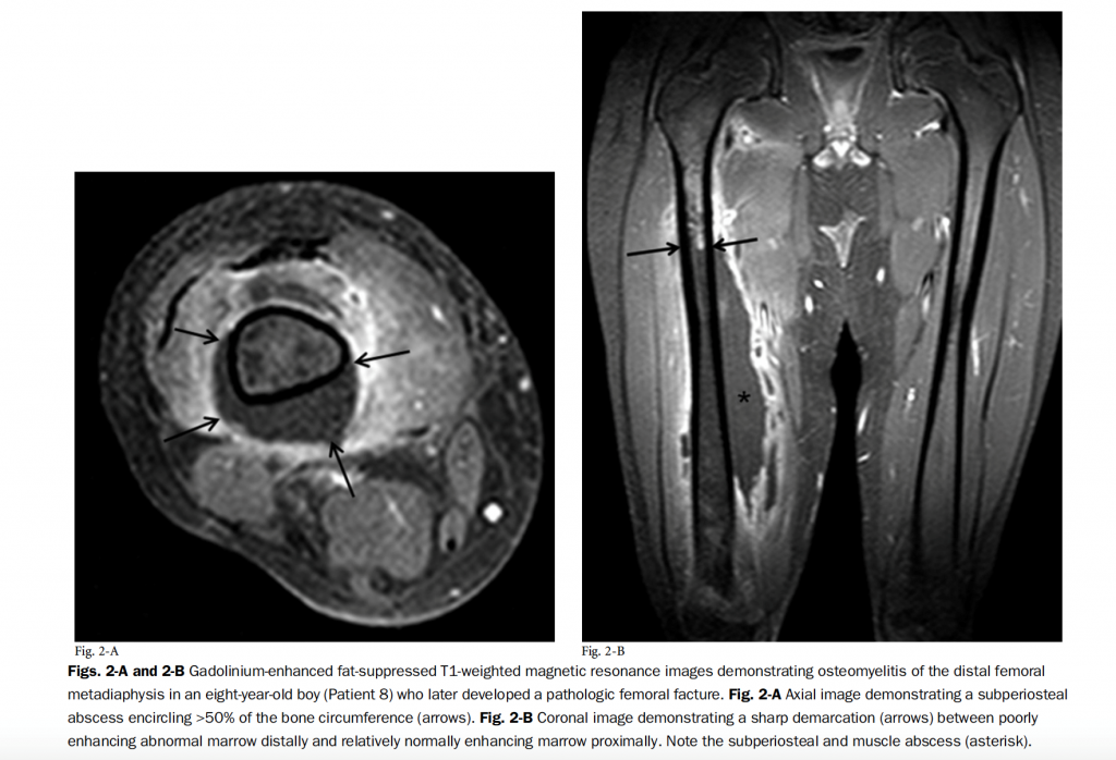 Pictures courtesy of Belthur MV, Birchansky SB, Verdugo AA, et al. Pathologic fractures in children with acute Staphylococcus aureus osteomyelitis. The Journal of Bone and Joint Surgery. 2012;94(1):34-42.